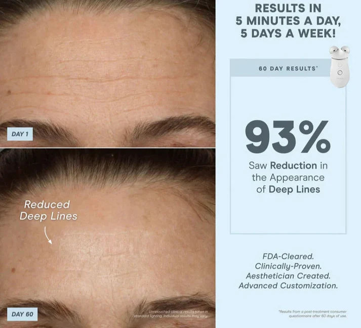 Mirqelle™ Massager Roller Anti Wrinkles