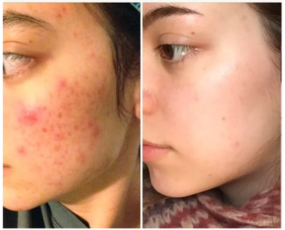Mirqelle™ High Frequency Therapy | Clear Acne and Prevent Future Breakouts