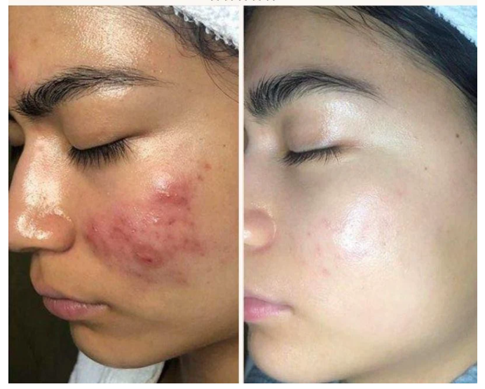 Mirqelle™ High Frequency Therapy | Clear Acne and Prevent Future Breakouts