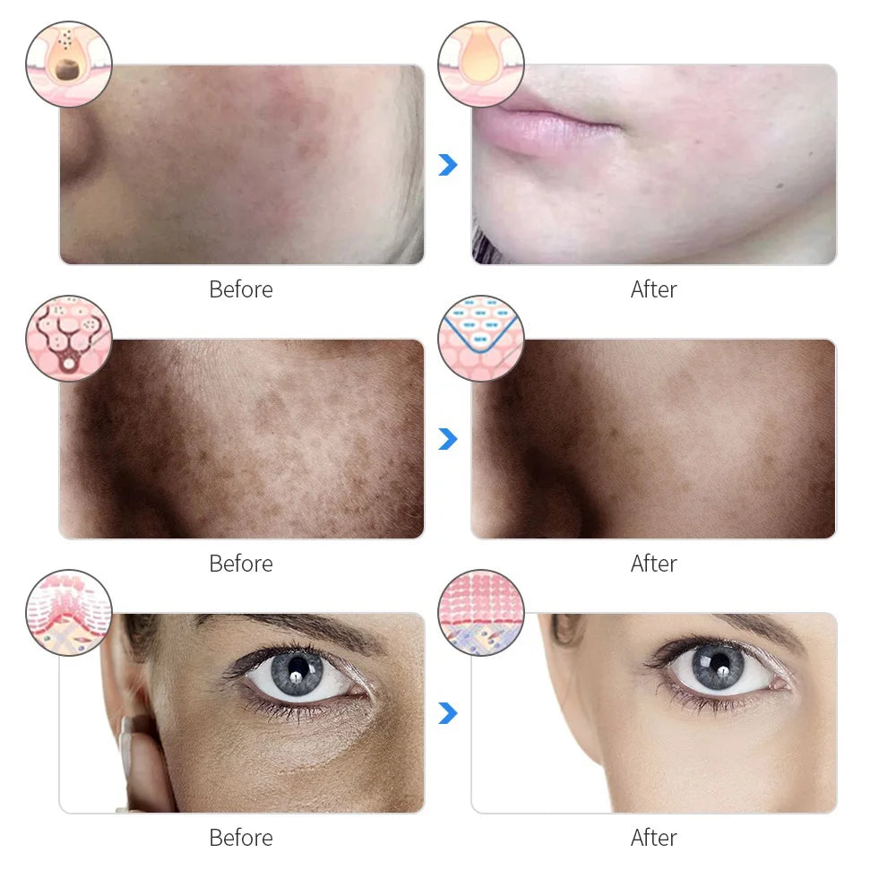 Mirqelle™ Photon Therapy Beauty Mask